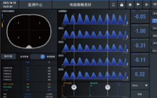 呼气末趋势ΔEELI